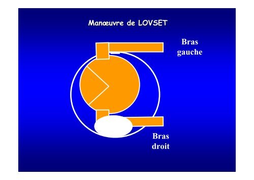 L'accouchement du siège pratique clinique