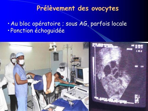 Techniques de l'assistance médicale à la procréation