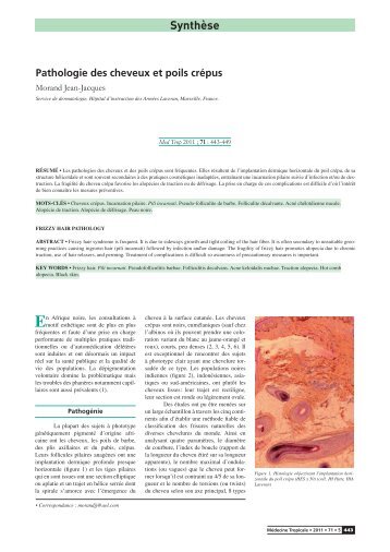 Synthèse Pathologie des cheveux et poils crépus