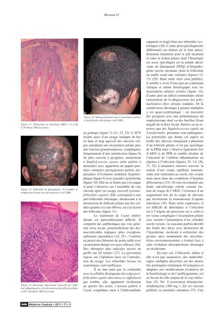 Synthèse Pathologie des cheveux et poils crépus
