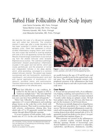 Tufted Hair Folliculitis After Scalp Injury - Skin & Allergy News