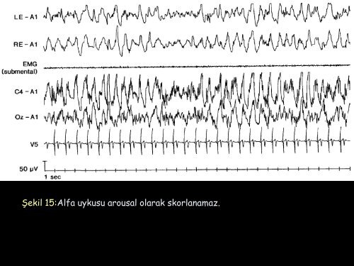 11. ulusal uyku tıbbı kongresi arousal skorlanması