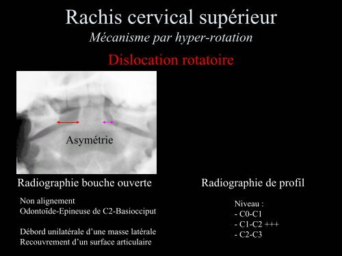 Pathologie du Rachis