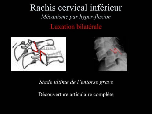 Pathologie du Rachis