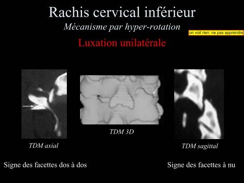 Pathologie du Rachis