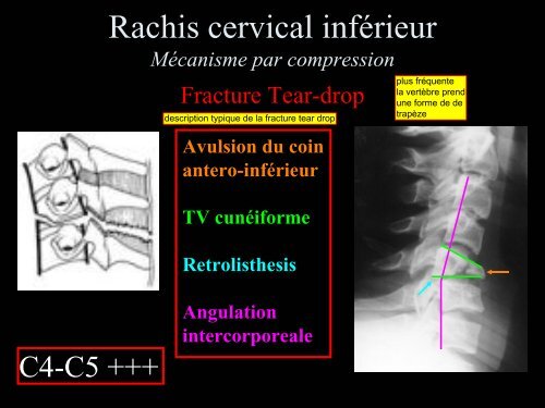 Pathologie du Rachis