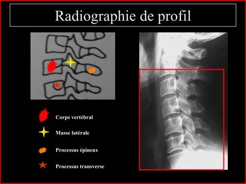 Pathologie du Rachis