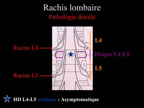 Pathologie du Rachis