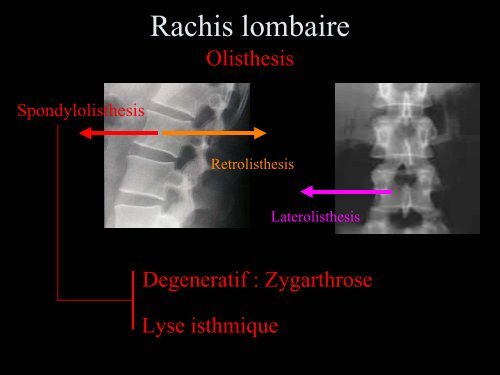 Pathologie du Rachis