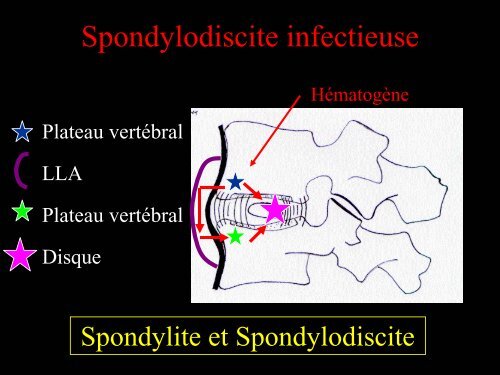 Pathologie du Rachis