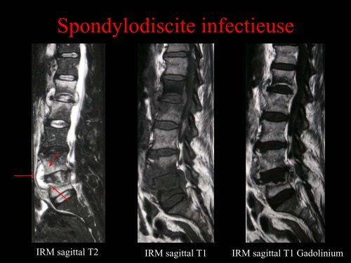 Pathologie du Rachis