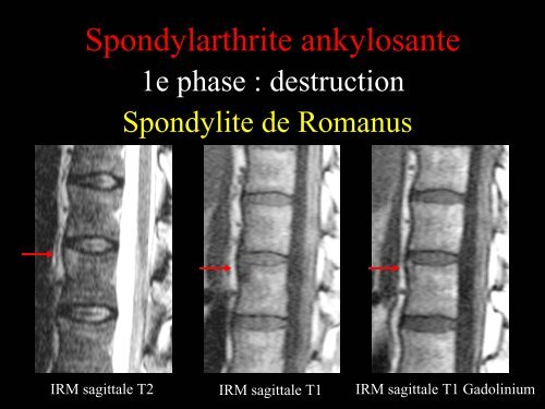 Pathologie du Rachis