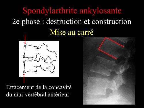 Pathologie du Rachis