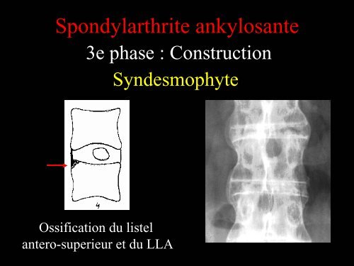 Pathologie du Rachis