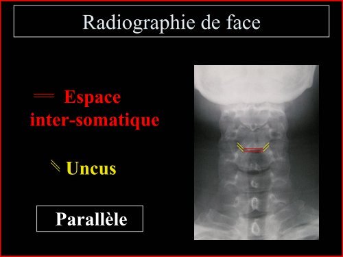 Pathologie du Rachis