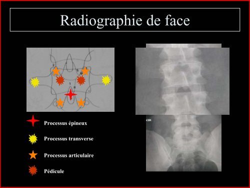 Pathologie du Rachis