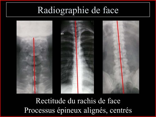 Pathologie du Rachis