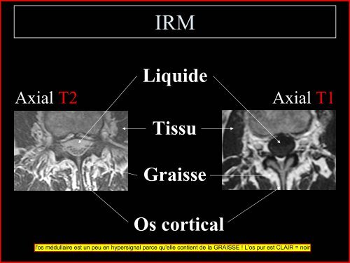 Pathologie du Rachis