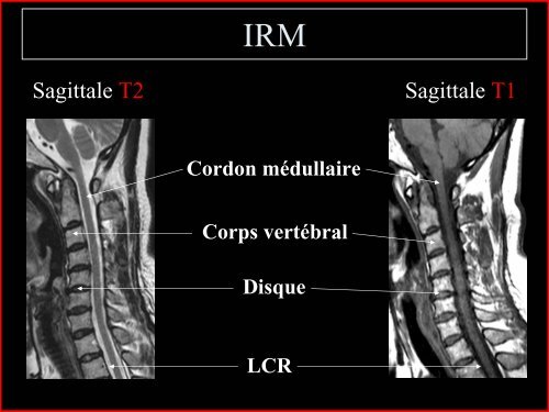 Pathologie du Rachis