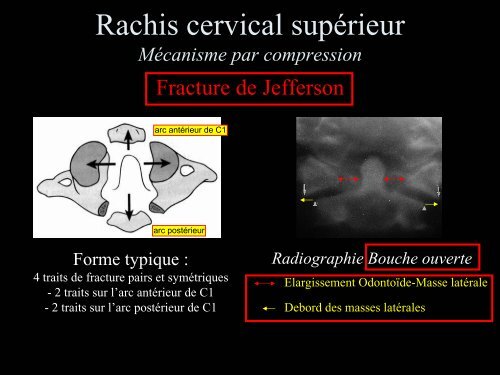 Pathologie du Rachis