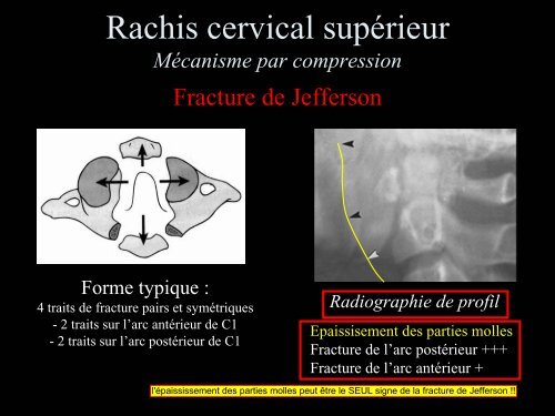 Pathologie du Rachis