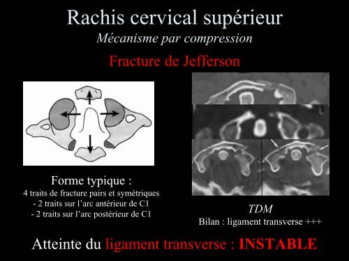 Pathologie du Rachis