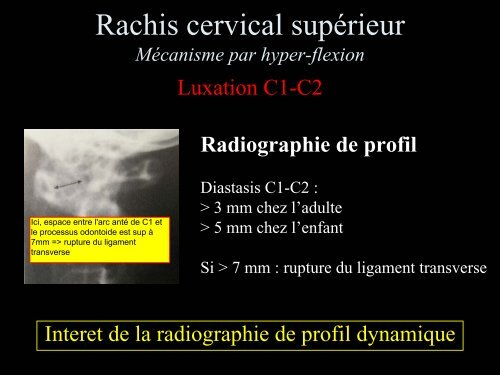 Pathologie du Rachis