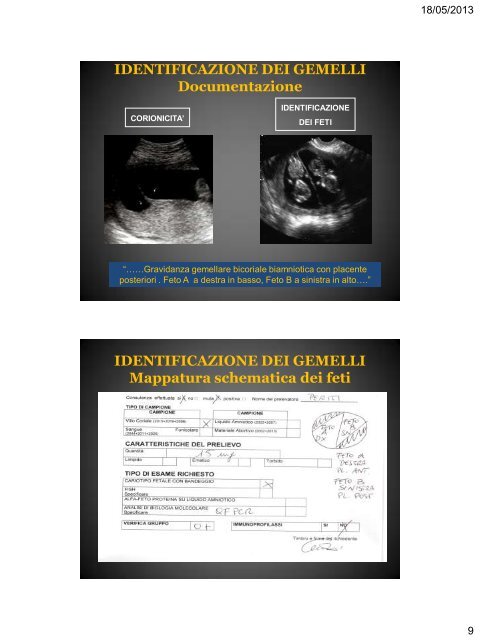 Diagnosi Prenatale Invasiva Problematiche - SIEOG