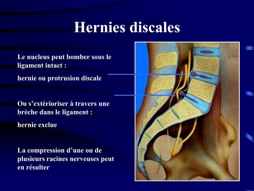 PATHOLOGIE RACHIDIENNE