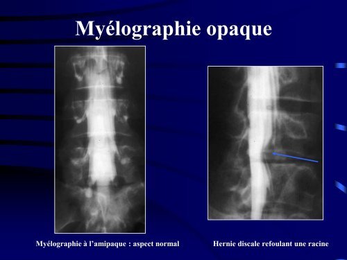 PATHOLOGIE RACHIDIENNE