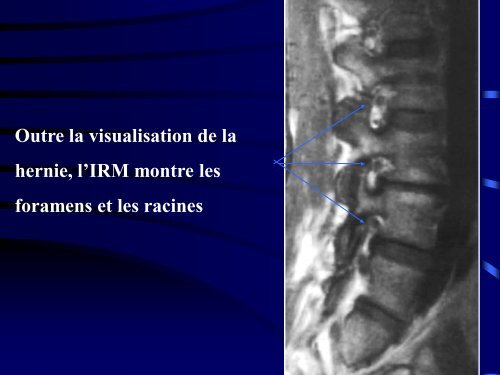 PATHOLOGIE RACHIDIENNE