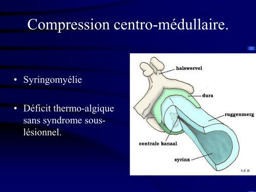 PATHOLOGIE RACHIDIENNE