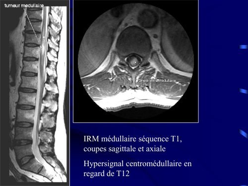 PATHOLOGIE RACHIDIENNE