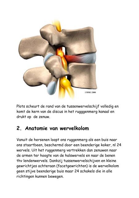 Lumbale discushernia - Stedelijk Ziekenhuis Roeselare