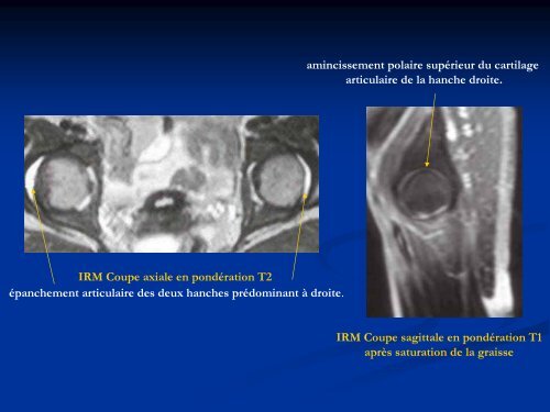 semiologie clinique et radiologique de la hanche douloureuse