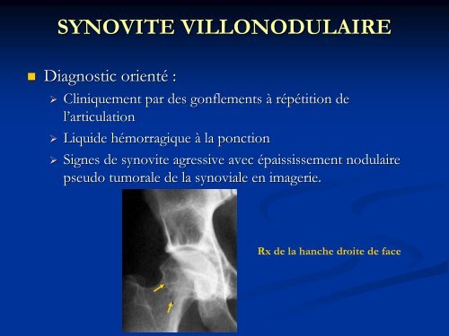 semiologie clinique et radiologique de la hanche douloureuse