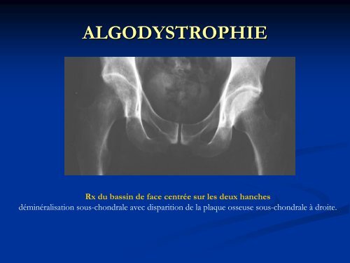 semiologie clinique et radiologique de la hanche douloureuse