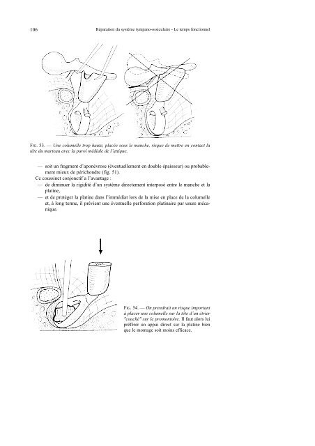 réparation du système tympano-ossiculaire le temps ... - ORL Nantes