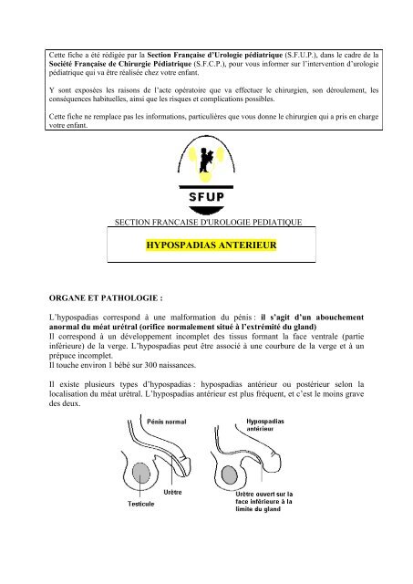 Hypospade Anterieur Societe Francaise De Chirurgie Pediatrique Hypospade Anterieur Societe Francaise De Chirurgie Pediatrique