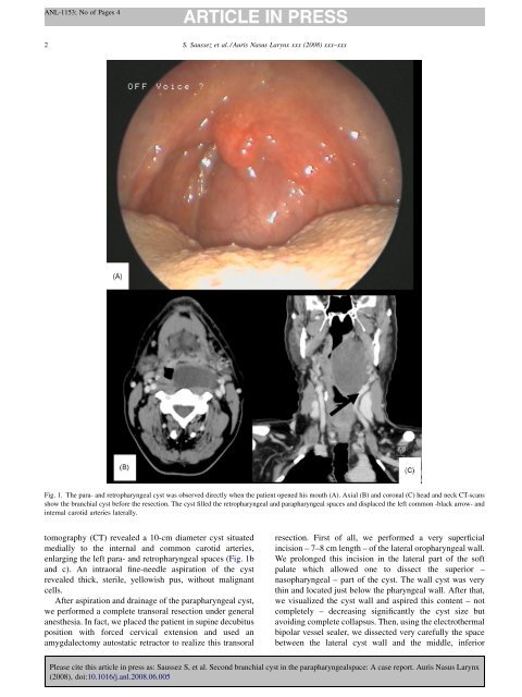 Second branchial cyst in the parapharyngealspace - Université de ...