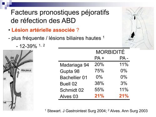 Indications et résultats des hépatectomies pour plaie biliaire