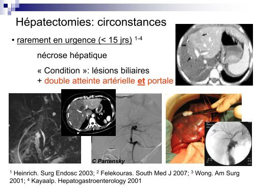 Indications et résultats des hépatectomies pour plaie biliaire