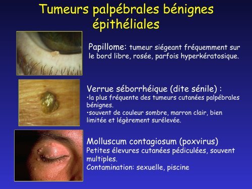 Pathologie des paupières