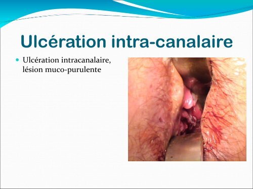 Gonococcie ano-rectale - Hepato Web