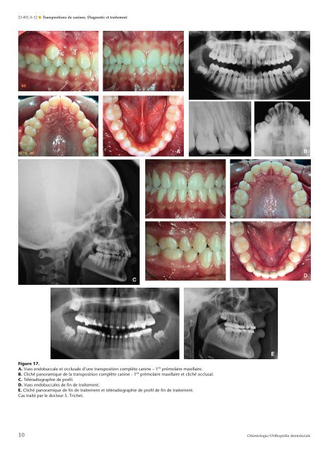 Transpositions de canines. Diagnostic et traitement - Belbacha Dental