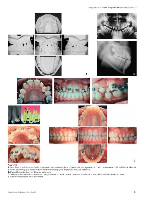 Transpositions de canines. Diagnostic et traitement - Belbacha Dental