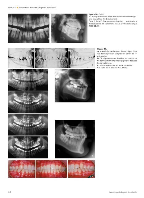 Transpositions de canines. Diagnostic et traitement - Belbacha Dental