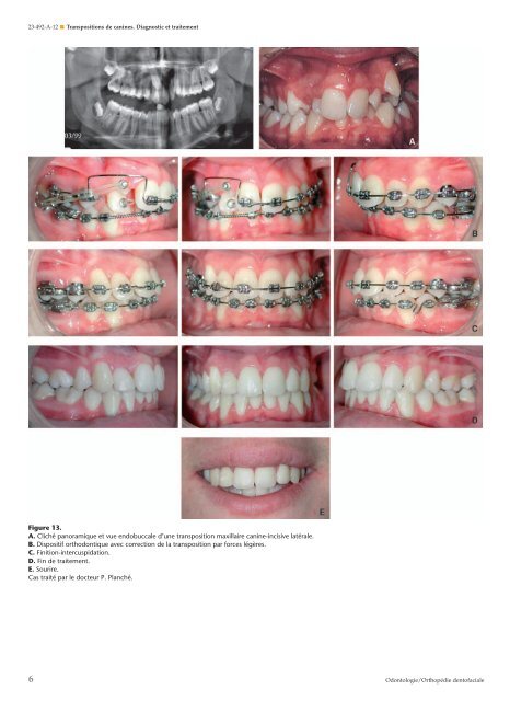 Transpositions de canines. Diagnostic et traitement - Belbacha Dental