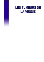 LES TUMEURS DE LA VESSIE