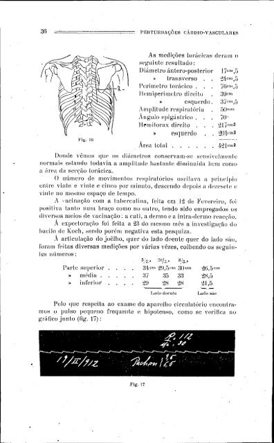 perturbações cárdio-Vasculares tuberculose pulmonar